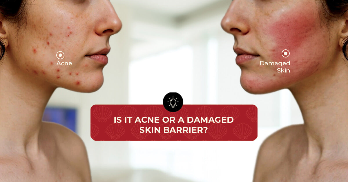 Is It Acne Or A Damaged Skin Barrier?