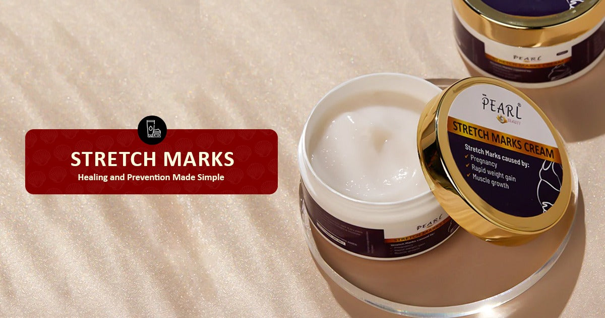 Stretch Marks Healing And Prevention Made Simple