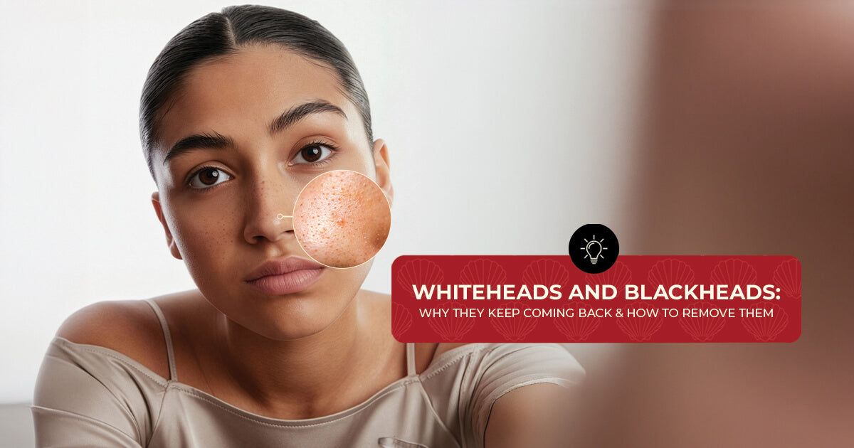 Whiteheads and Blackheads: Why They Keep Coming Back & How to Remove Them