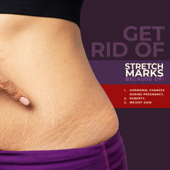 Stretch Marks Removal Cream To Reduce Stretch Marks & Scars| Delivery Stretch Marks Removal Cream