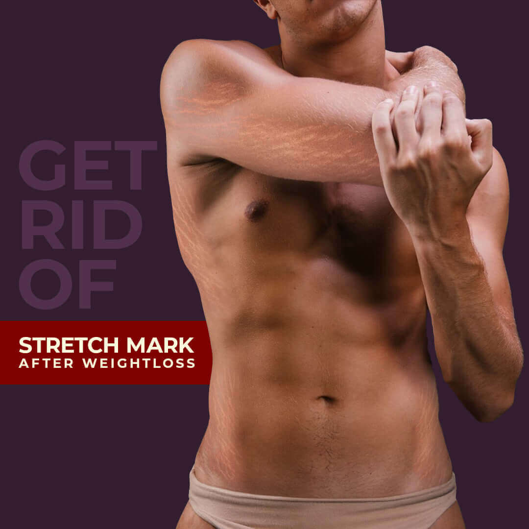 get rid of stretchmarks after weightloss ARM Pearl